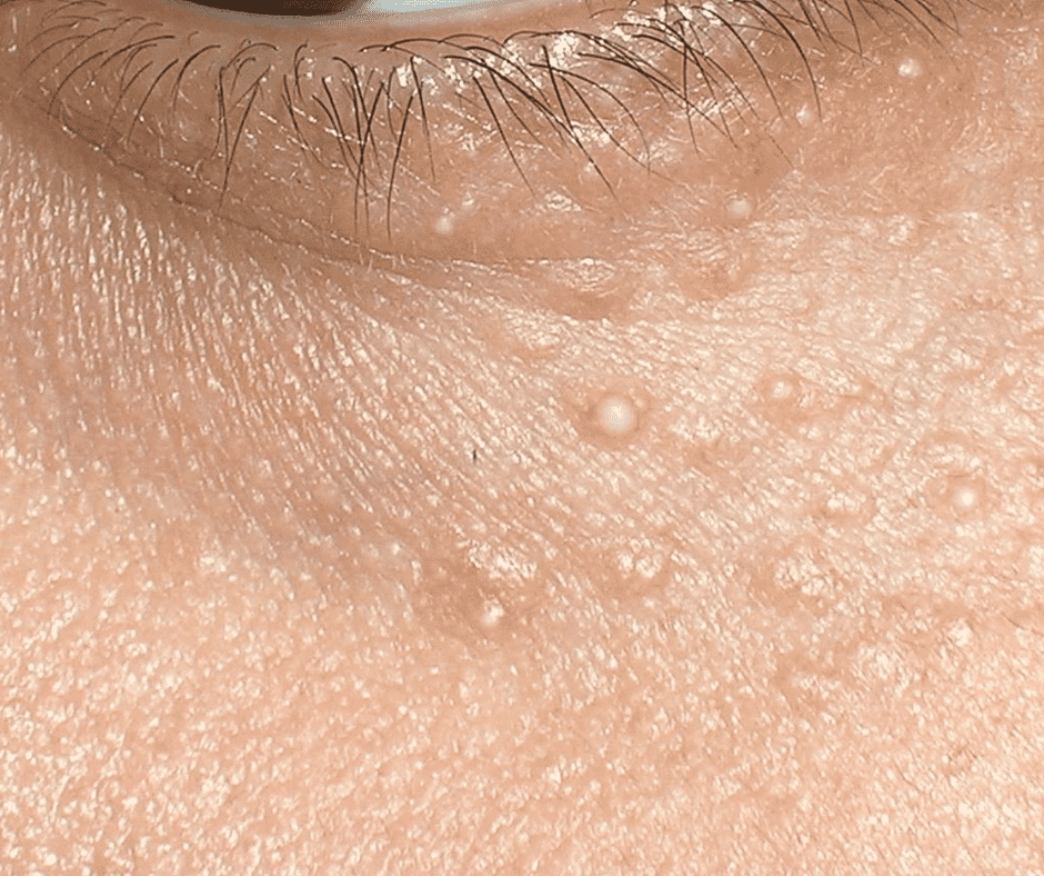 Syringoma on the skin of the bottom eyelid