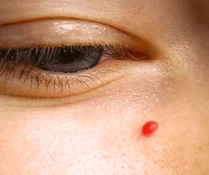 Red Cherry Angioma Under The Eye