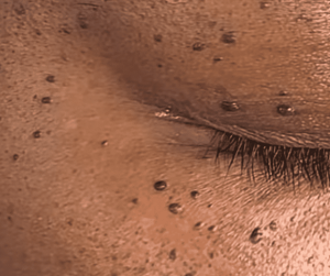 Appearance of Angiomas on darker skin types