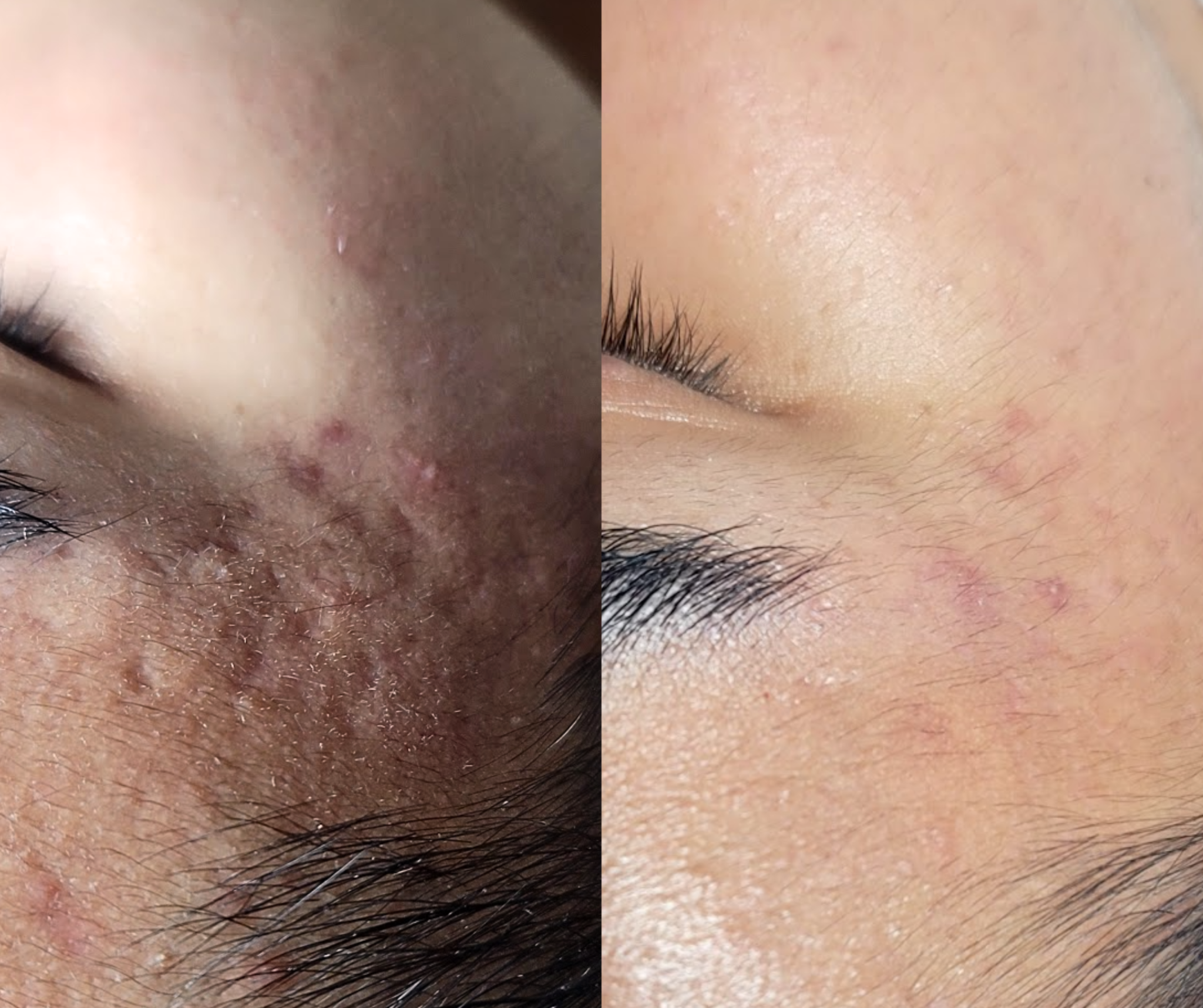 Before and after of acne scar removal by La Clinica