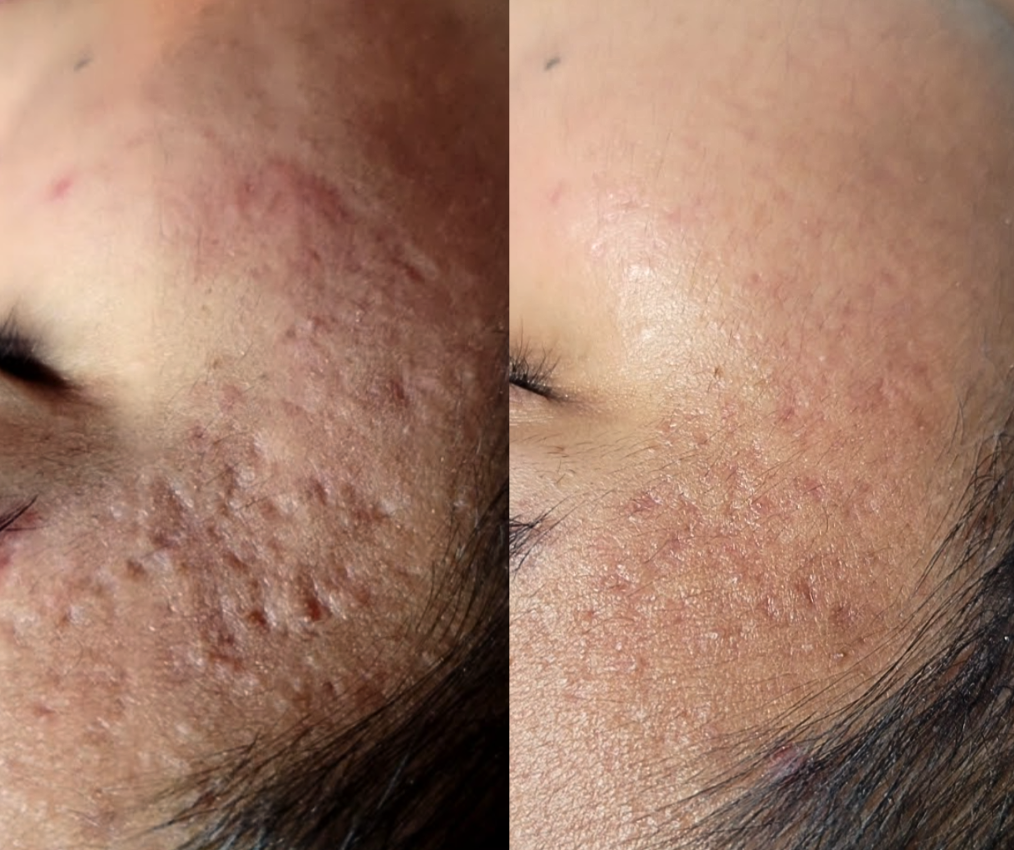 Before and after progression of acne scar removal by La Clinica